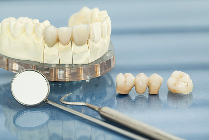 Restoration of Dental Crowns, Bridges and Implants