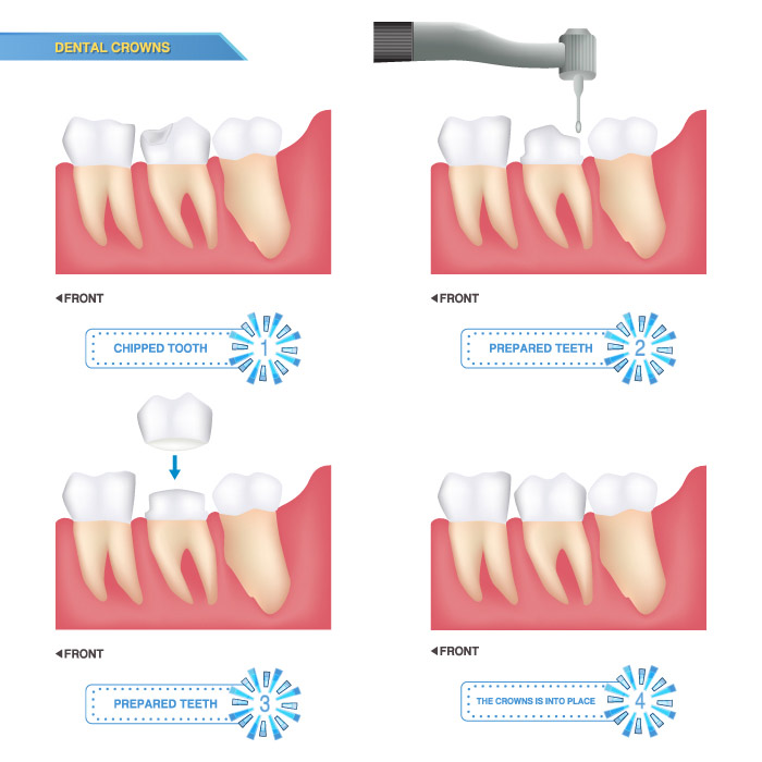 Dental Crowns and Tooth Structure