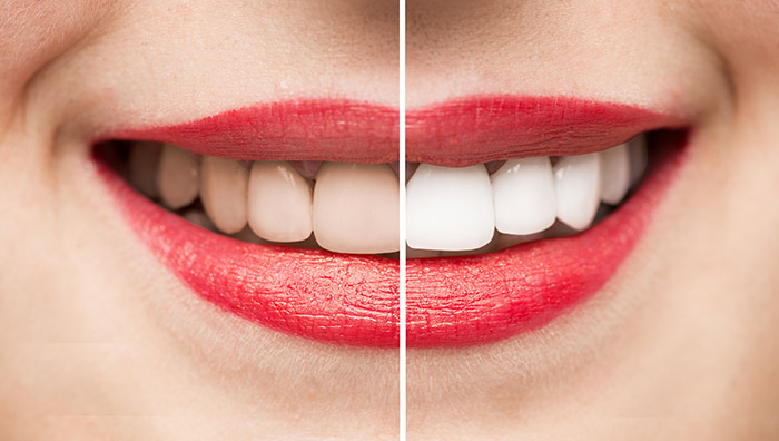 Take Home Teeth Whitening Kit Results