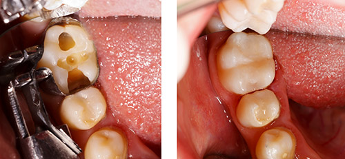 Composite Tooth Filling Before and After